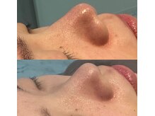 ナチュウル(Natulu)/ハイドラ毛穴洗浄