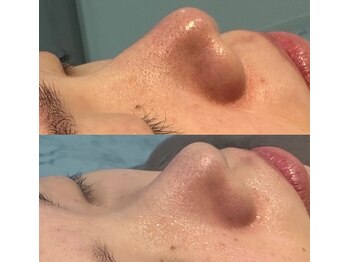 ナチュウル(Natulu)/ハイドラ毛穴洗浄