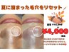 【毛穴大掃除】毛穴エクストラクション（鼻のみ）　¥15,000→¥4,000