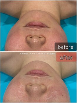 サロン テン(salon TEN)/泡洗浄で毛穴ケア