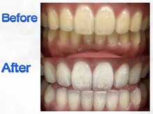 LBSホワイトニング 梅田店/ホワイトニングビフォーアフター