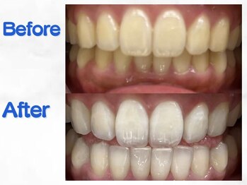 LBSホワイトニング 梅田店/ホワイトニングビフォーアフター