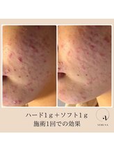 ラトワ(LATOWA)/棘あり　ハードハーブ