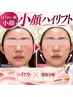 【2回目～/参考価格】ほうれい線/たるみケア│小顔ハイリフト×小顔脂肪分解