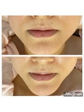 ティーダ(Ti-Da)/小顔ぷりっともちもちになる！