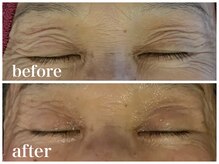 ルー ハナレ 神戸岡本 摂津本山店(Luu HANARE)/小顔リフトアップ　しわ改善