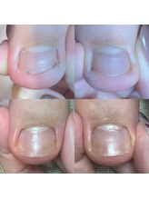 キュア(Cure.)/フットケアで陥入爪の悩み解消