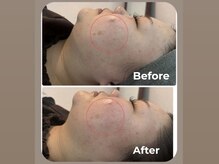 ベルシア(BELXIA)/輪郭もスッキリハーブピーリング