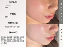 ルディラ 銀座店/水玉グロウリフト(韓国式LDM)