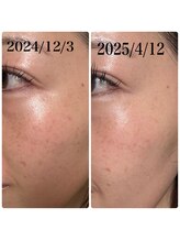 アール(R)/【　肌質改善　】