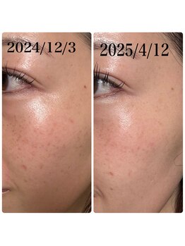 アール(R)/【 肌質改善 】