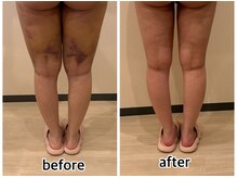 インディバジェム(GEM)/ビフォーアフター