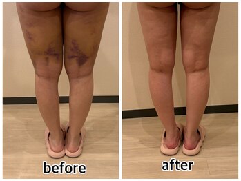 インディバジェム(GEM)/ビフォーアフター