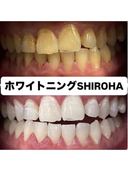 シロハ(SHIROHA)/セルフホワイトニング/天王寺
