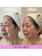 ココロ(COCORO)/エイジングケア　1か月の変化