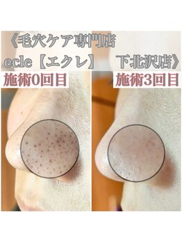 エクレ 下北沢店(ecle)/回数を重ねるごとに違いを実感♪