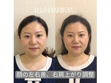 リス(R.i.S)/小顔矯正Before&After