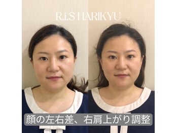 リス(R.i.S)/小顔矯正Before&After