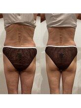 ミ ライト(m light)/ボディのたるみ徹底改善