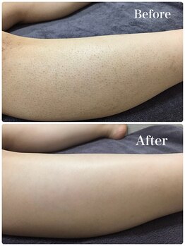 ハダハダ(HADA HADA Medical Esthetic)/ツルツルな足へ導きます♪