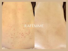 ラフェーム(RAFEMME)の雰囲気（《リアボーテ》フェイシャルトリートメント♪肌の土台作りから！）