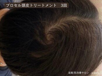 ジュパール(je pars)/プロセル頭皮トリートメント