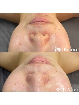 アンバー(amber)/小鼻の黒ずみ毛穴にも！