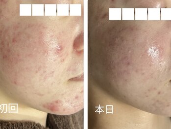 リボーン(REBORN)/ハーブピーリング