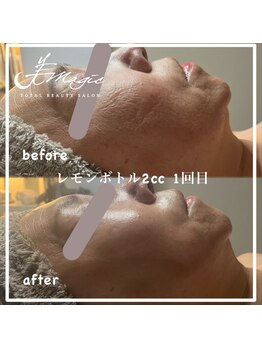 ビーマジック(美magic)/レモンボトル