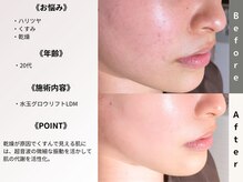 ルディラ 銀座店/水玉グロウリフト(韓国式LDM)