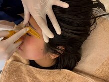 《お顔のシュガーリング》毛だけじゃなく皮脂や毛穴の汚れ除去♪