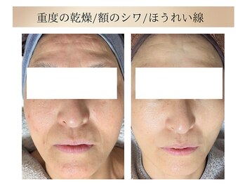 エボルブ 四条烏丸店(EVOLVE)/幹細胞ハーブピーリング