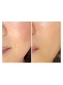 小顔屋オテテ(Otete)/BeforeAfter