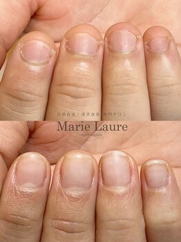マリーロール 梅田店(Marie Laure)/自爪育成/深爪矯正/ネイルケア