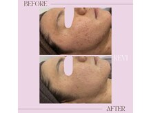 ホワイトラボ ライカム前店(White labo)/肌質改善☆REVIハーブピーリング