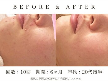 ロエヴェ(ROEWE)/ニキビ改善・毛穴ケア・肌質改善