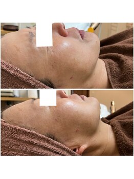 カヌヌ(Kanunu)/小顔リフト