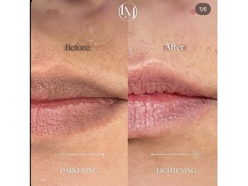 リレイスフクオカ(RelaceFUKUOKA)/メラニンケア【ルメラ】