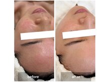 オルネ(ORNE.)/赤みの改善はNK細胞美容