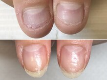 グラシュータン(gracieux temps)/【深爪矯正13000円】