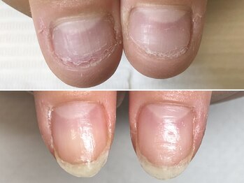 グラシュータン(gracieux temps)/【深爪矯正13000円】