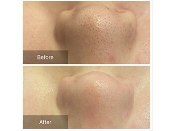 リジュベ(Rejuve)/毛穴エクストラクション[本八幡]