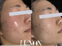 ルノン(Lunon)/肌質改善　《途中経過》