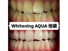アクア 池袋店(AQUA)/ホワイトニング/池袋/東京/美白