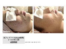 マイプラ(mypla)/光フェイシャル「ニキビ」