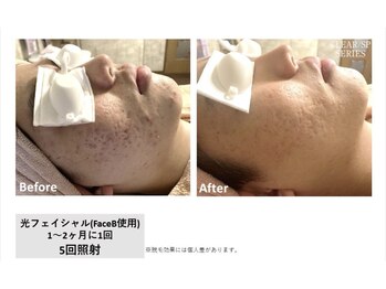 マイプラ(mypla)/光フェイシャル「ニキビ」