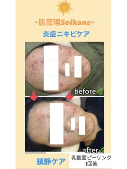 ソルカナ(Solkana)の写真/【何をやってもダメだったそんなあなたの長年の肌悩み根本から改善いたします】熊本No. 1のサービスを★

