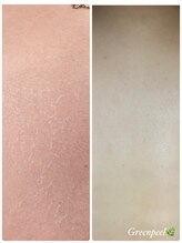 オアジスパ(Oasi Spa)/Greenpeel1回