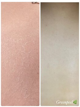 オアジスパ(Oasi Spa)/Greenpeel1回