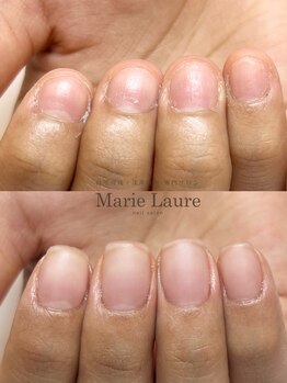 マリーロール 梅田店(Marie Laure)/自爪育成/深爪矯正/ネイルケア